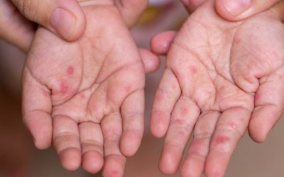 Mengenal Flu Singapura: Gejala, Penyebab, dan Cara Pencegahannya